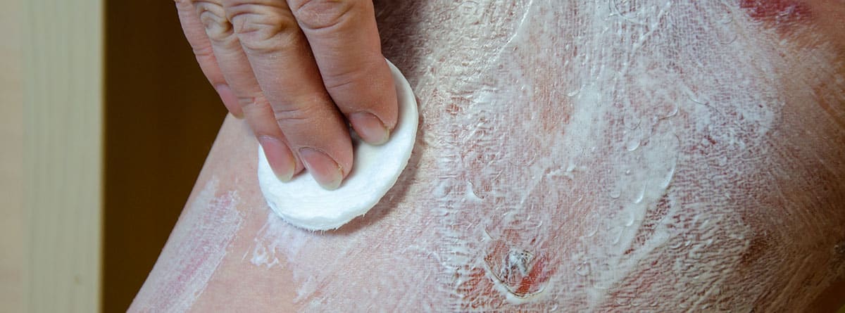 Tratar quemaduras de segundo grado: mujer poniendo una crema con un algodón sobre una quemadura