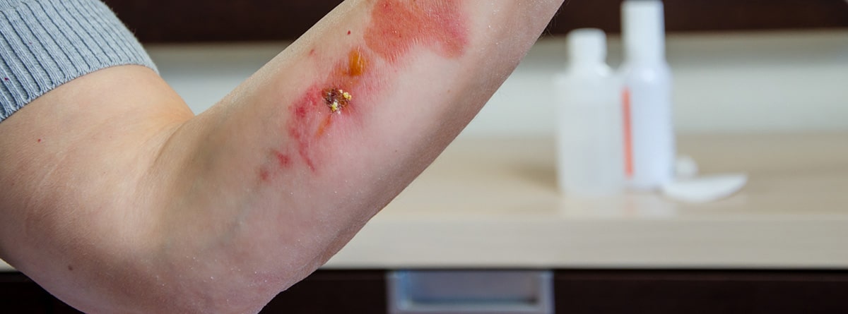 Cómo tratar quemaduras de segundo grado: brazo con quemaduras