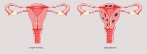Asenomiosis: Órganos del sistema reproductivo enfermos y normales