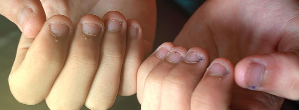 Morderse las uñas: manos con las uñas mordidas