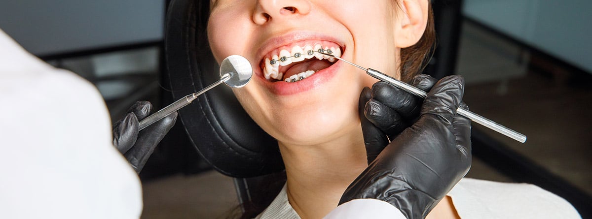 Ortodoncia invisible o brackets: mujer con la boca abierta en el dentista colocando unos brackets