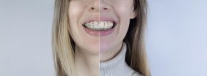 ¿Ortodoncia invisible o brackets?: cara de mujer con la boca abierta enseñando la mitad brackets y la otra mitad ortodoncia invisible