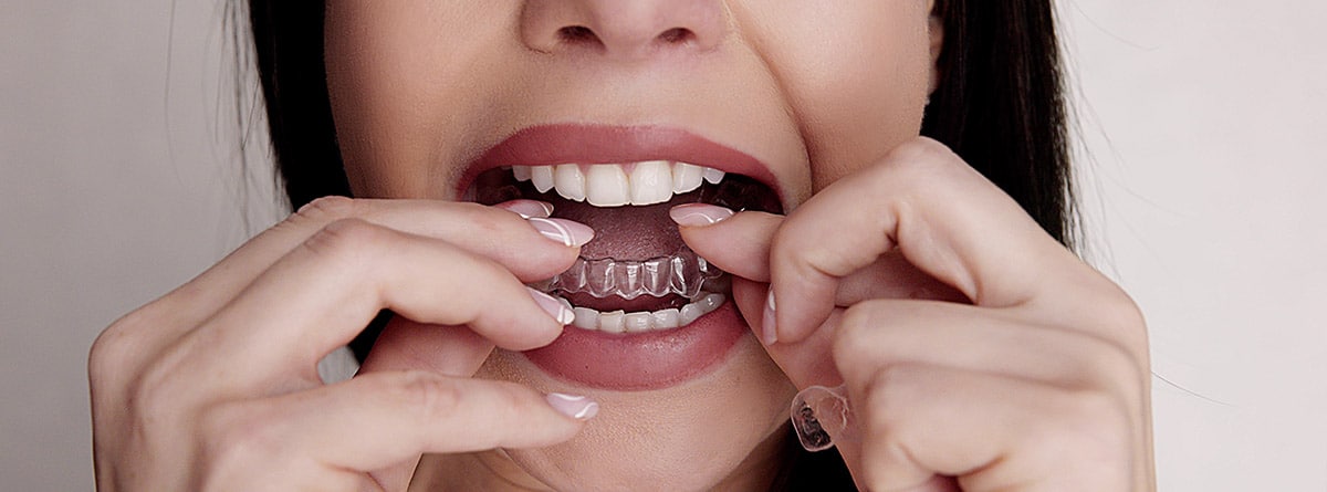 Ortodoncia invisible o brackets: mujer con la boca abierta introduciendo una ortodoncia invisible