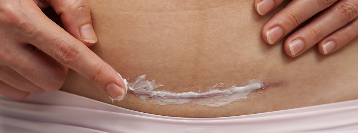 ¿Cómo es la recuperación tras una cesárea?: Mujer poniendo crema curativa en la cicatriz de cesárea.