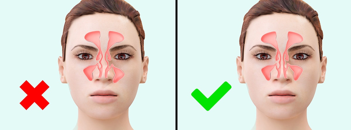 Dolor en el tabique nasal: mujer con corrección del tabique nasal antes y después