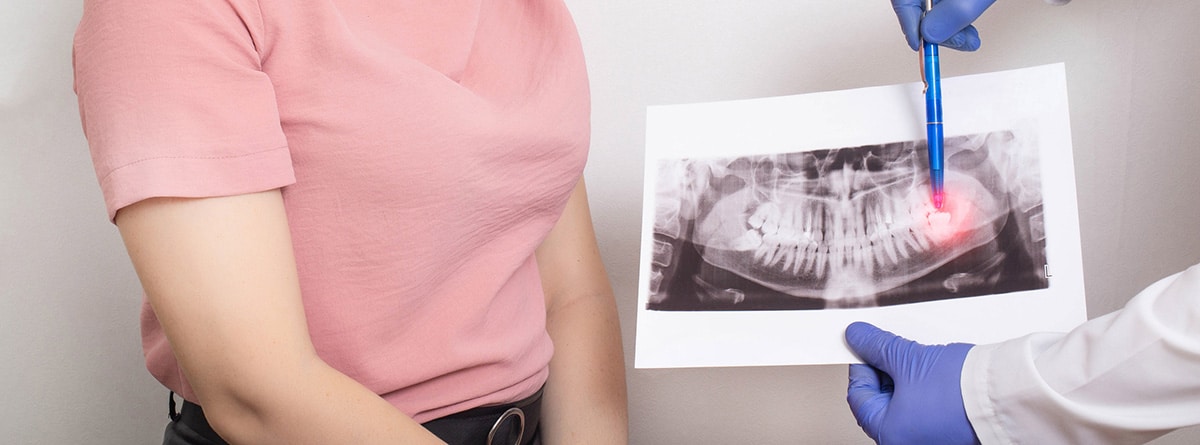 Cuando salen las muelas del juicio: busto de mujer en consulta del dentista y doctor enseñando una radiografía de la boca, donde se refleja las muelas del juicio