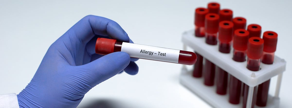 Pruebas de alergia en sangre: mano con guante azul sujetando un tubo de sangre con pegatina de test de alergia