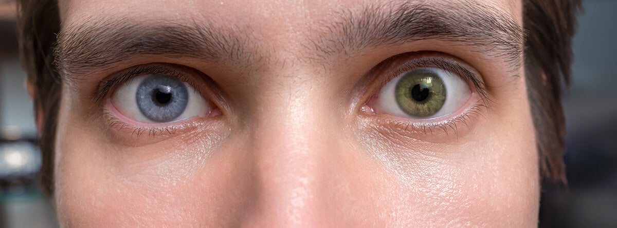 Heterocromía: ojos de hombre de distinto color, uno verde y otro azul