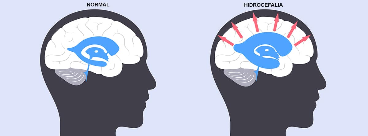 Anatomía del cerebro, uno normal y el otro con hidrocefalia