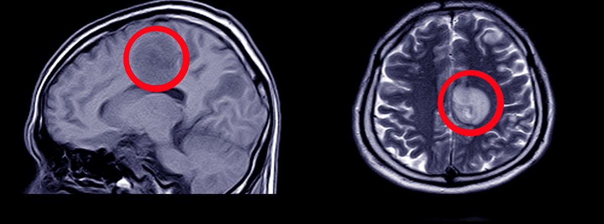 resonancia magnética del cerebro