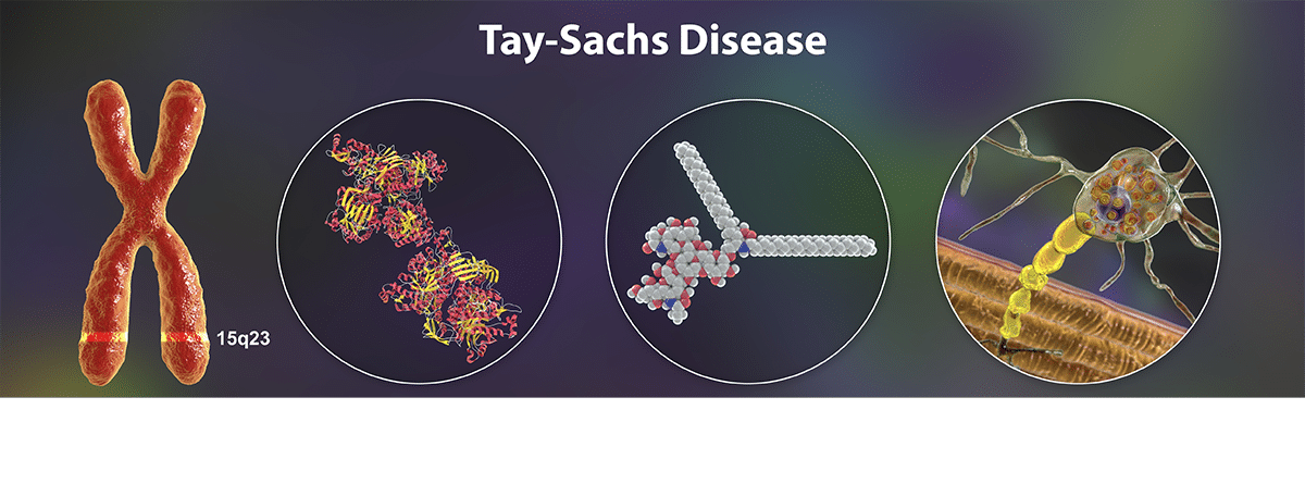 evolución enfermedad de Tay-Sachs