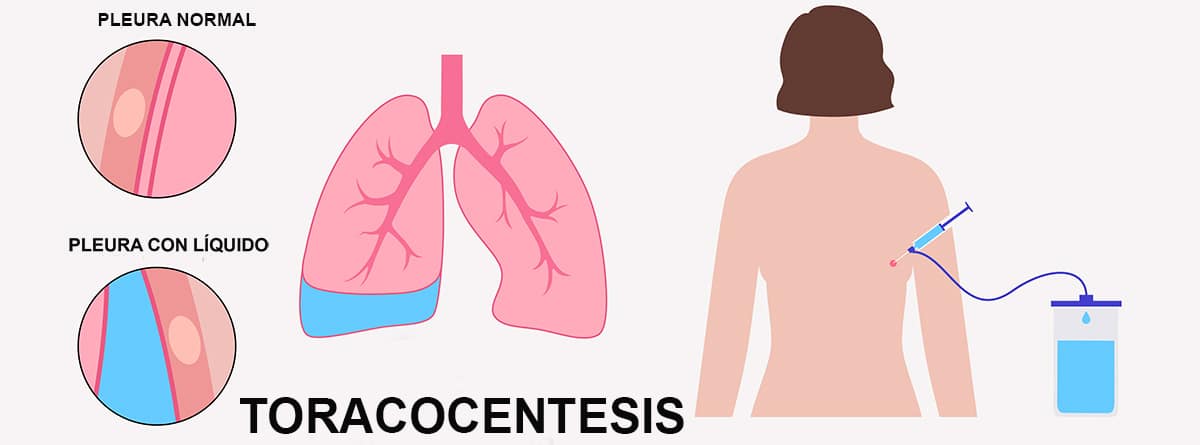 Ilustración de una toracocentesis