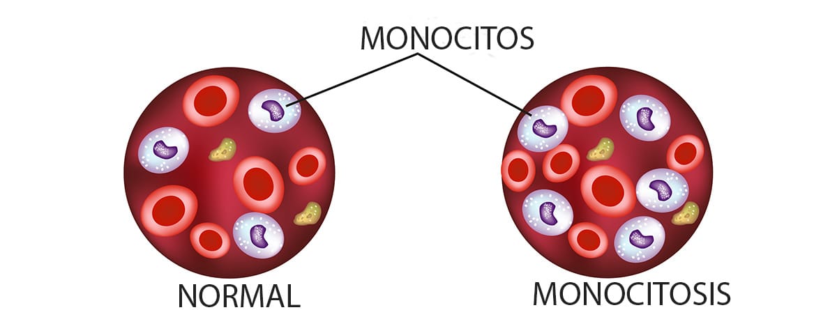 Monocitos por encima del rango normal en la sangre. Monocitosis. 
