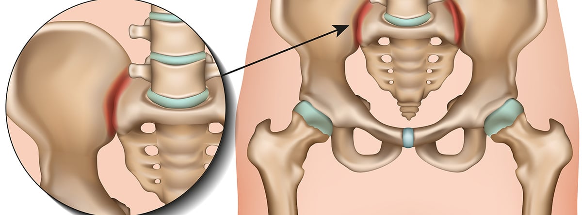 Ilustración de Inflamación de la articulación sacroilíaca
