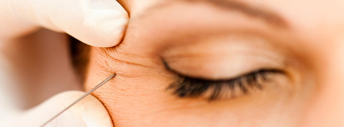 inyección de botox en la arruga cerca del ojo de una mujer
