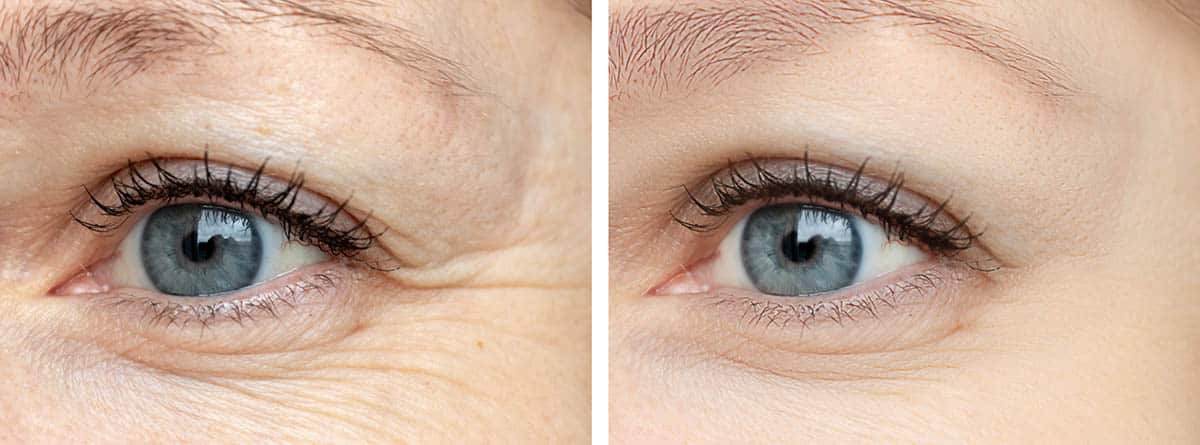 Rostro de mujer, arrugas de los ojos antes y después del tratamiento con botox