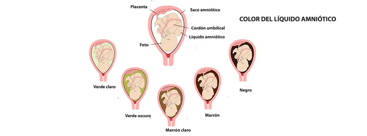 Color del líquido amniótico en el saco amniótico. Variantes normales y peligrosas. 