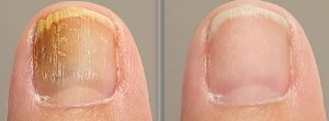 Antes y después del tratamiento antimicótico tópico se observa en el dedo gordo del pie de una persona que sufre onicomicosis