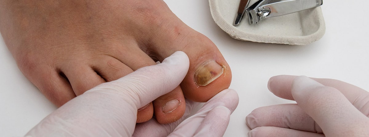 Las manos de médico con guantes médicos, examinando la uña del dedo del pie
