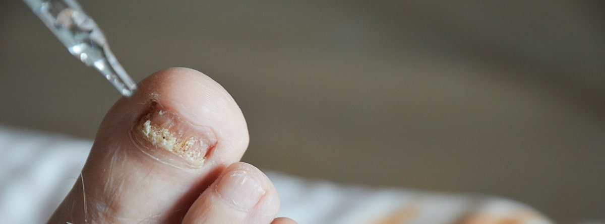 tratamiento de gotas para las uñas de los pies