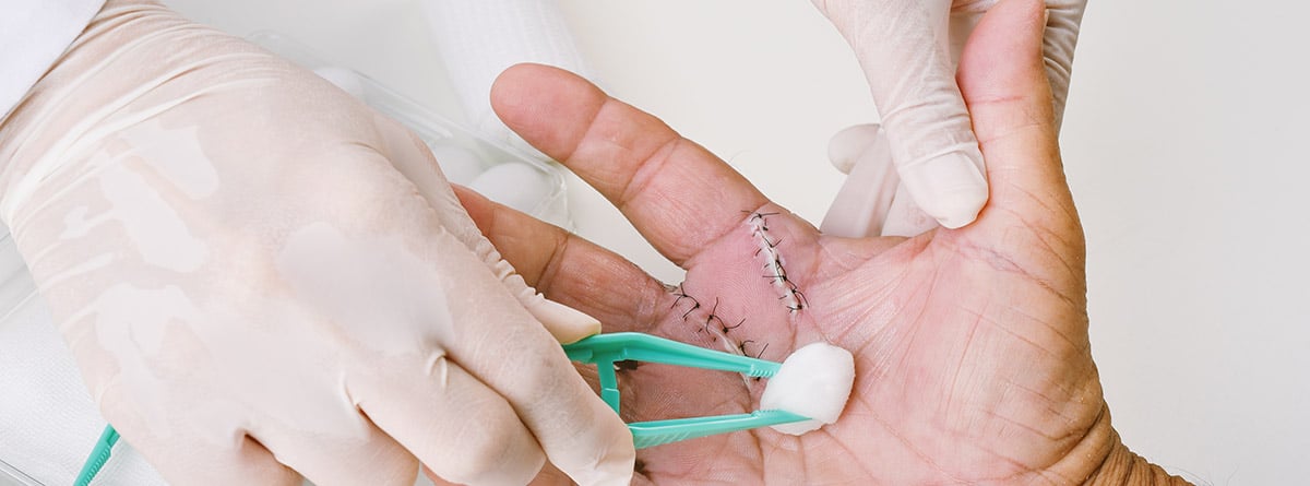 doctor haciendo una cura de una operación del dedo en gatillo