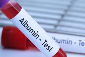 Tubo de sangre en laboratorio con la palabra albúmina