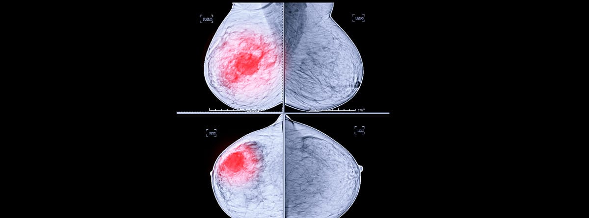 Mamografía digital de rayos X, vista CC lateral y MLO. mamografía o exploración de mama para detectar cáncer de mama que muestre BI-RADS 4 Sospechoso.