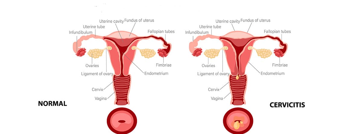 Ilustración de cervicitis