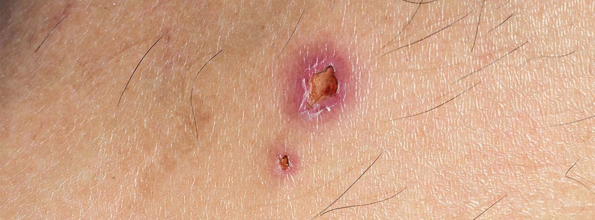 Lunares y manchas en la piel