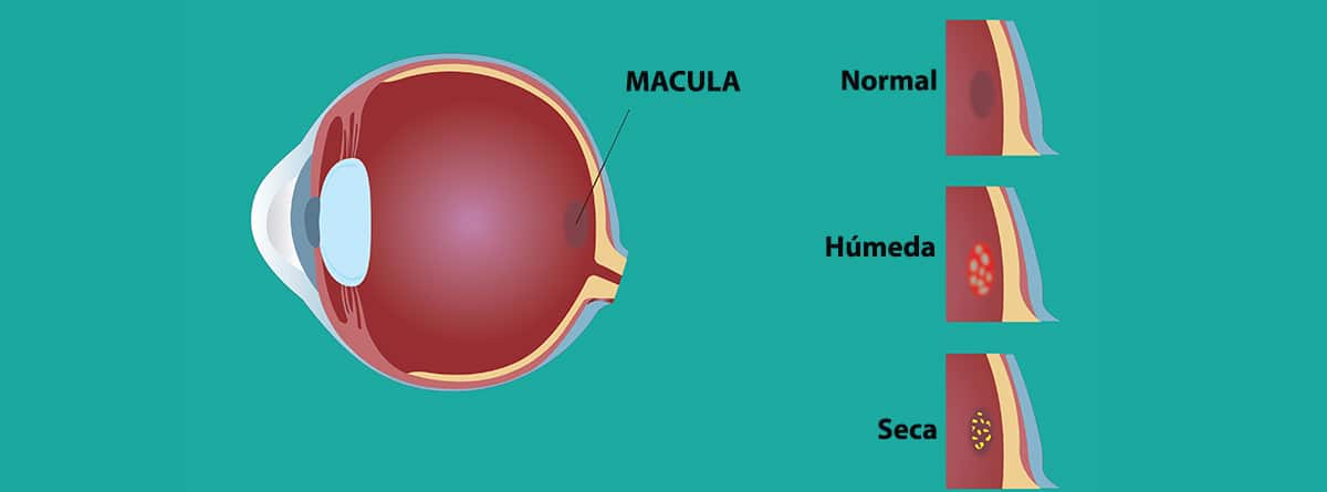 imagen de la degeneración macular: normal, húmeda. seca