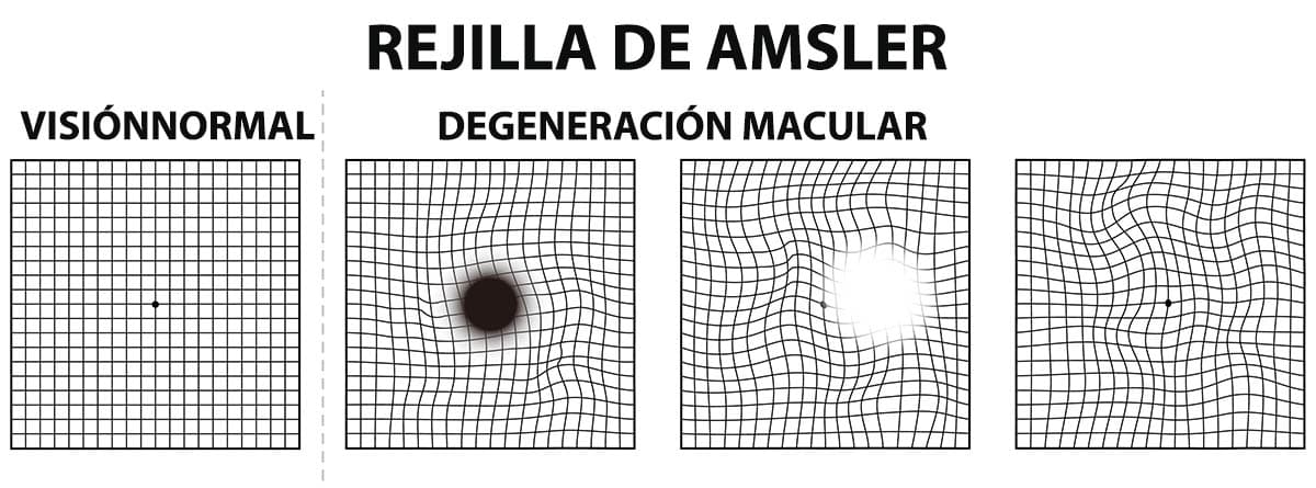 Rejilla de Amsler: degeneración macular relacionada con la edad, visión normal, centro oscuro, falta parcial, visión distorsionada