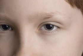 niña con las pupilas dilatadas