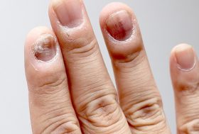 Uñas con hemorragia en la uña