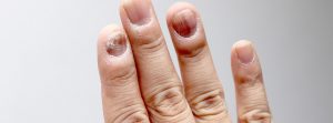 Uñas con hemorragia en la uña
