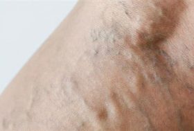 Pierna con varices