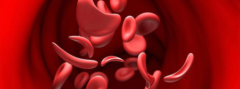 Anemia de células falciformes
