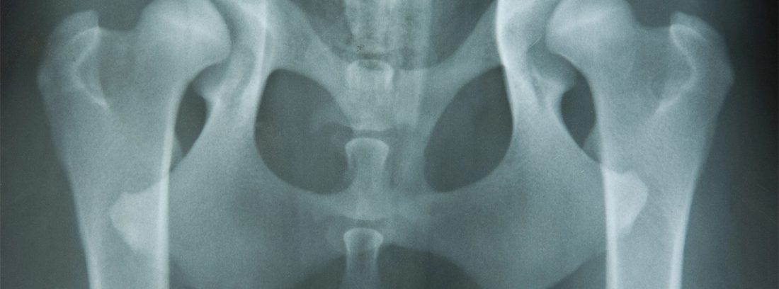 radiografía de cadera