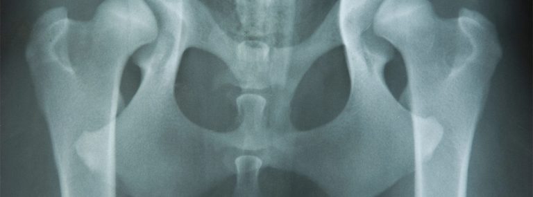 radiografía de cadera