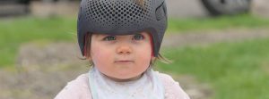 Bebé con casco correctivo braquicefalia
