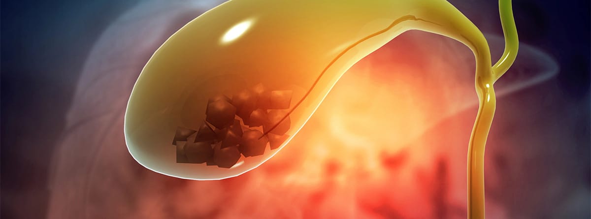 Cáncer de vesícula