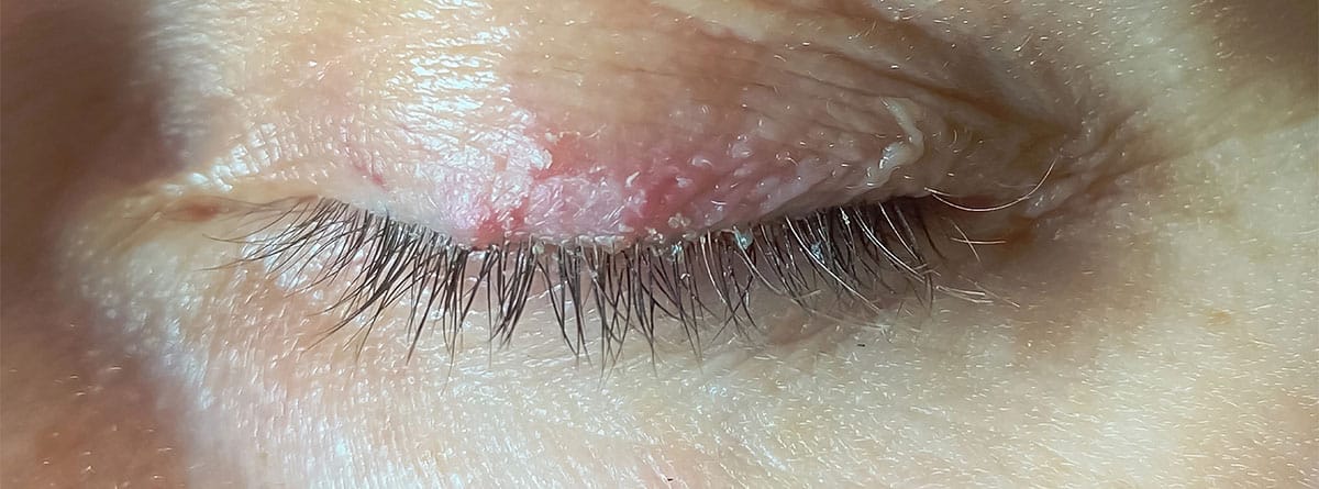 Dermatitis palpebral