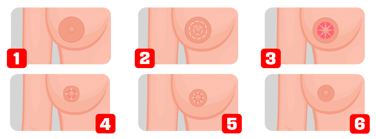 Infografía reducción areola