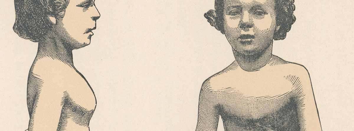 Ilustración de un niño con una deformidad estructural del tórax