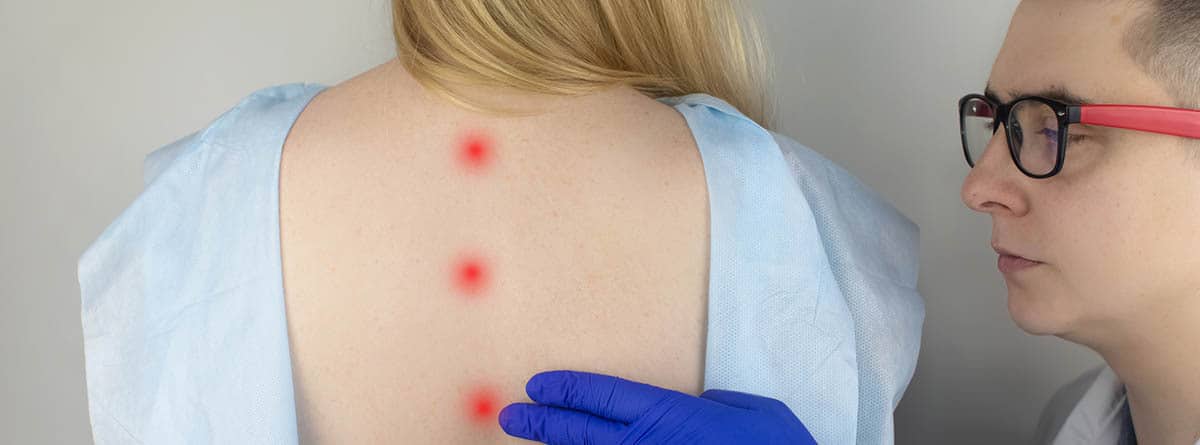 Espalda de una chica rubia con puntos rojos que marcan un problema de escoliosis