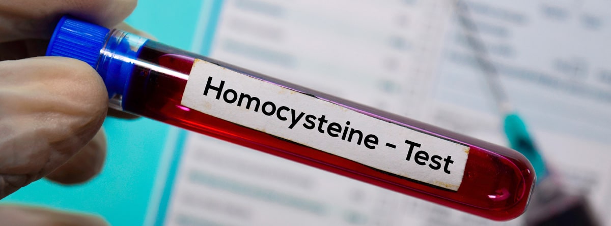 Tubo de análisis de sangre con etiqueta de homocisteína