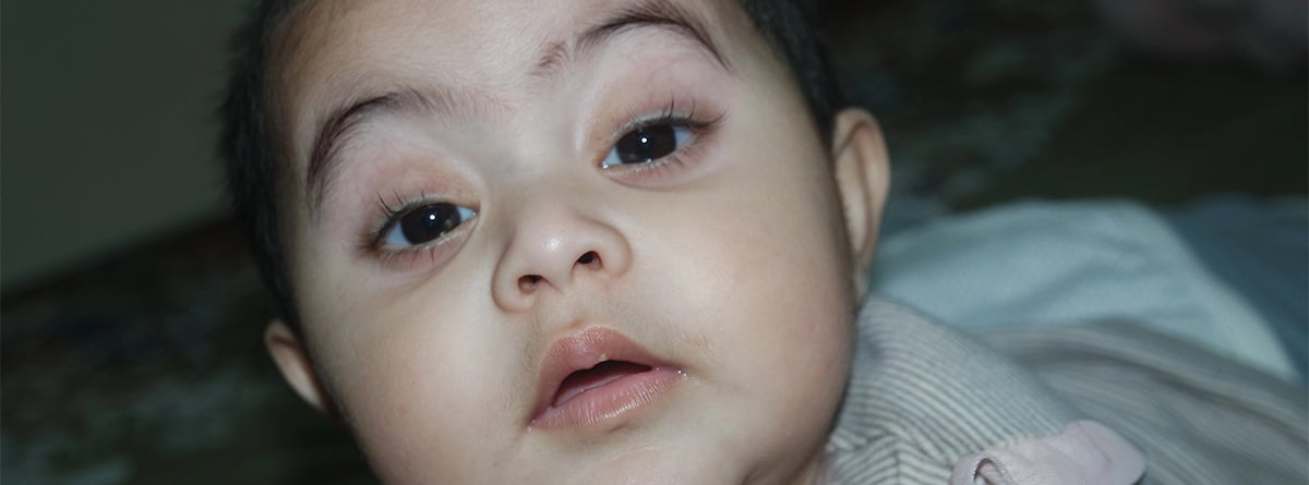Bebé con síndrome kabuki