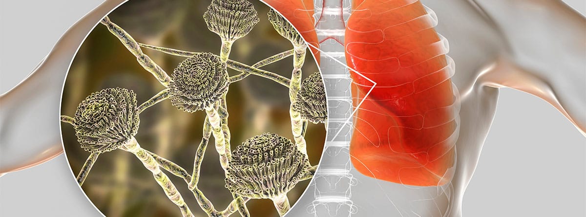 Ilustración de hongos en el pulmon