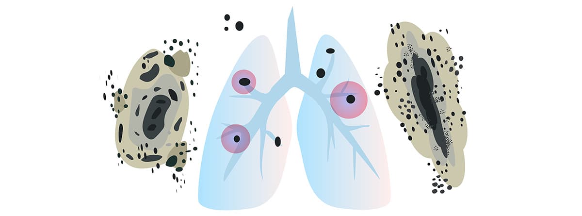 Ilustración de infección pulmonar hongos