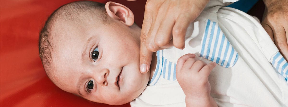 Mandíbula retrognatia congénita Bebé