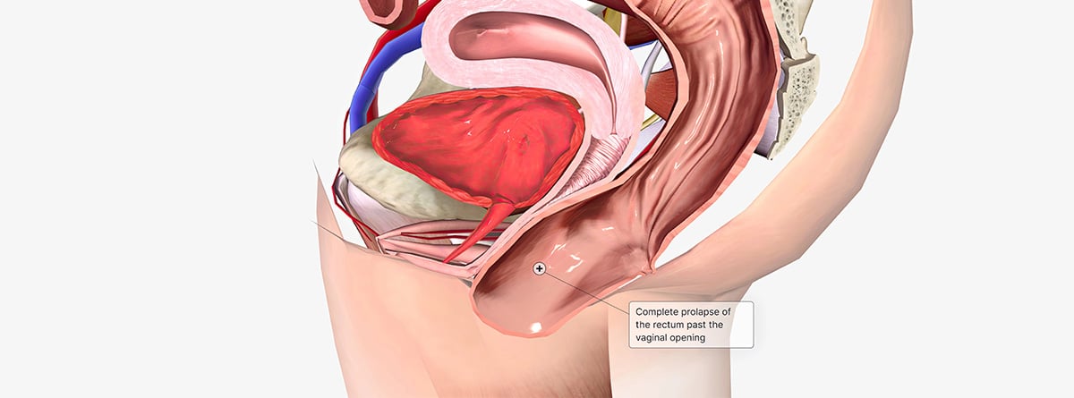 Ilustración 3d sobre prolapso rectal